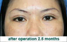 plastic-surgery-blepharoplasty